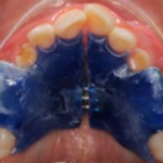 Ortodoncia interceptiva, ¿en qué consiste?